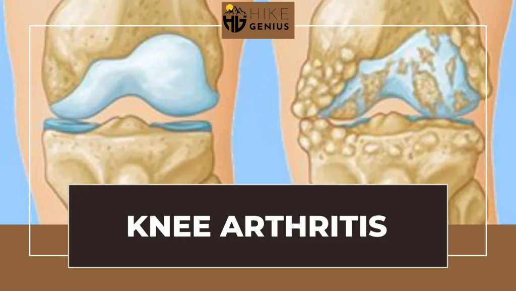 Knee-Arthritis-Cause-of-knee-pain-when-hiking-downhill